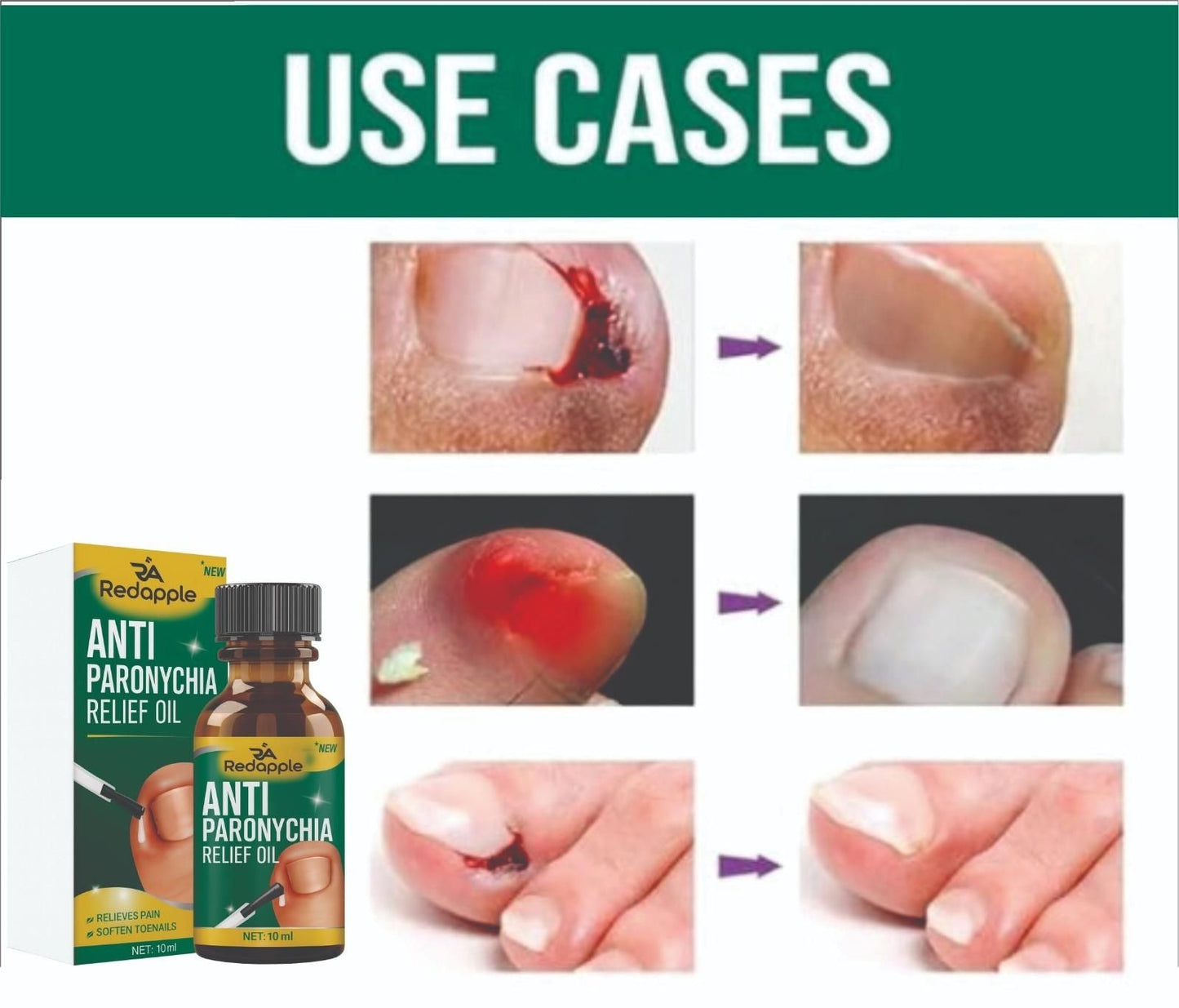 Anti Paronychia Relief Oil 20 ml Pack of 2